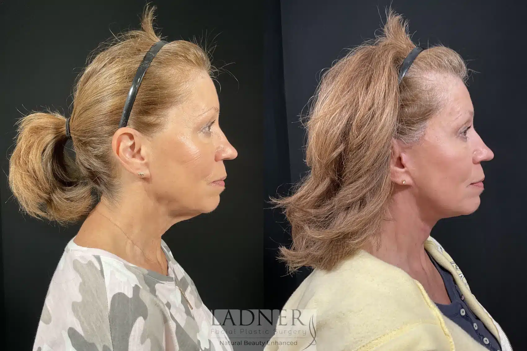 Before and After Image: Deep Plane Facelift/Neck Lift - right-side