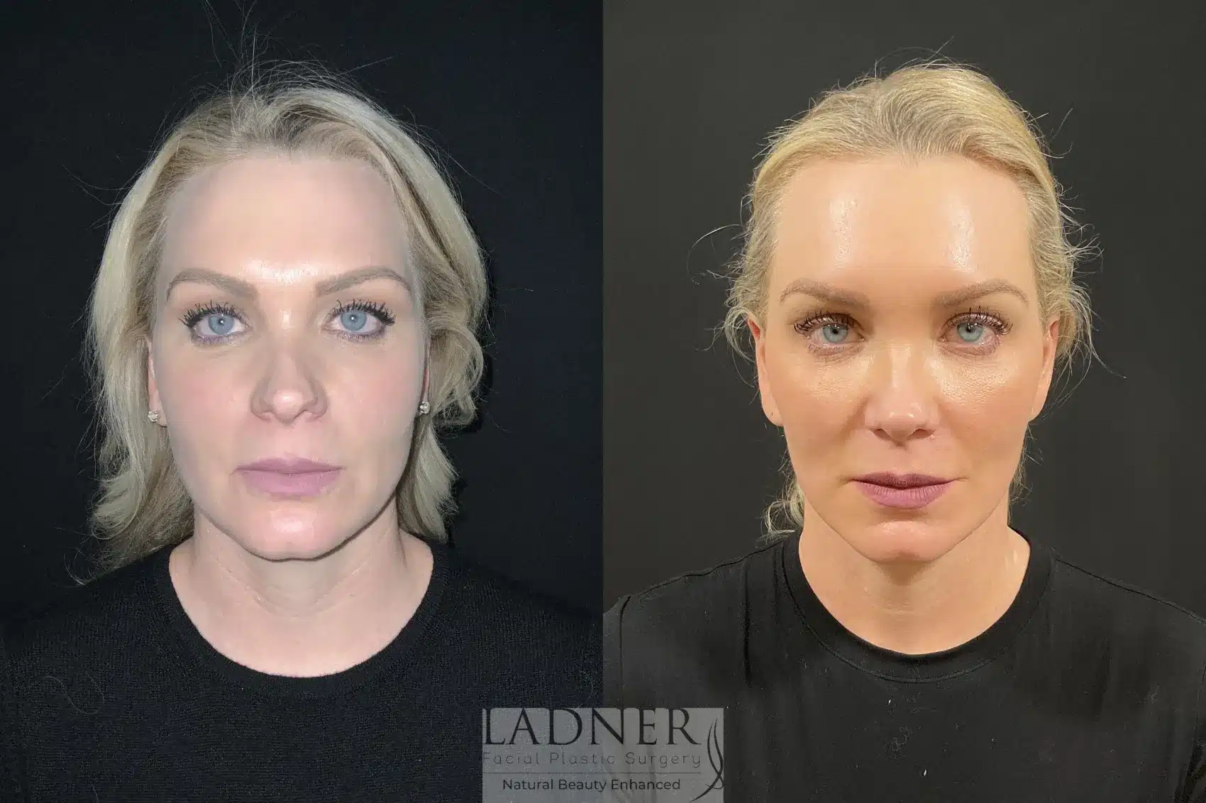 Before and After Image: Deep Plane Necklift/Deep Plane Lower Facelift - front