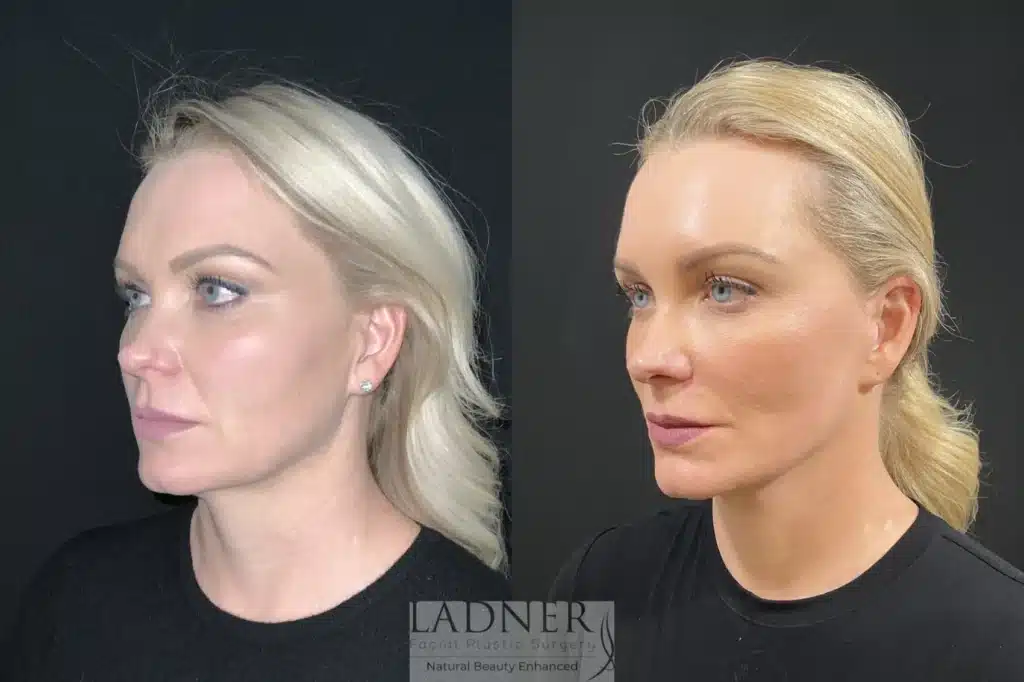Before and After Image: Deep Plane Necklift/Deep Plane Lower Facelift - left-front-oblique