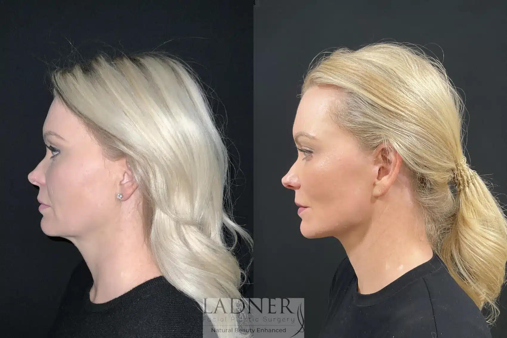 Before and After Image: Deep Plane Necklift/Deep Plane Lower Facelift - left-side