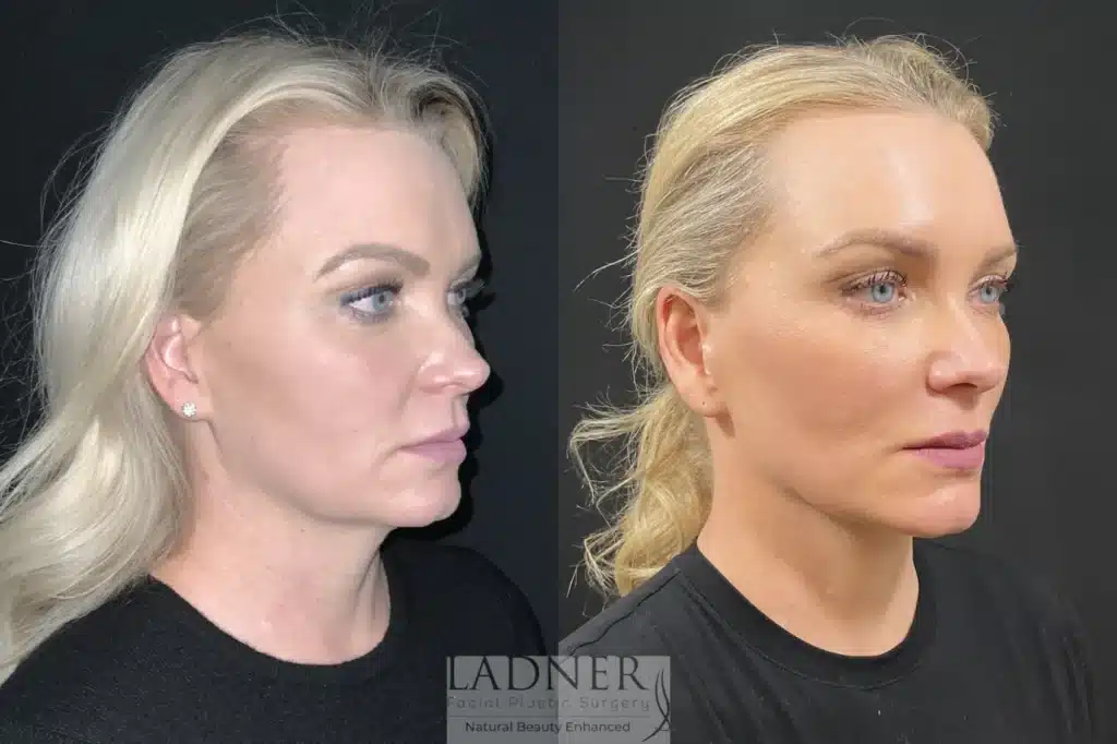 Before and After Image: Deep Plane Necklift/Deep Plane Lower Facelift - right-front-oblique