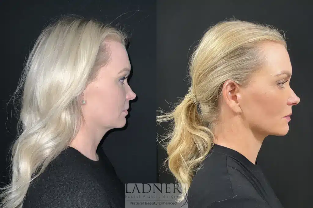 Before and After Image: Deep Plane Necklift/Deep Plane Lower Facelift - right-side