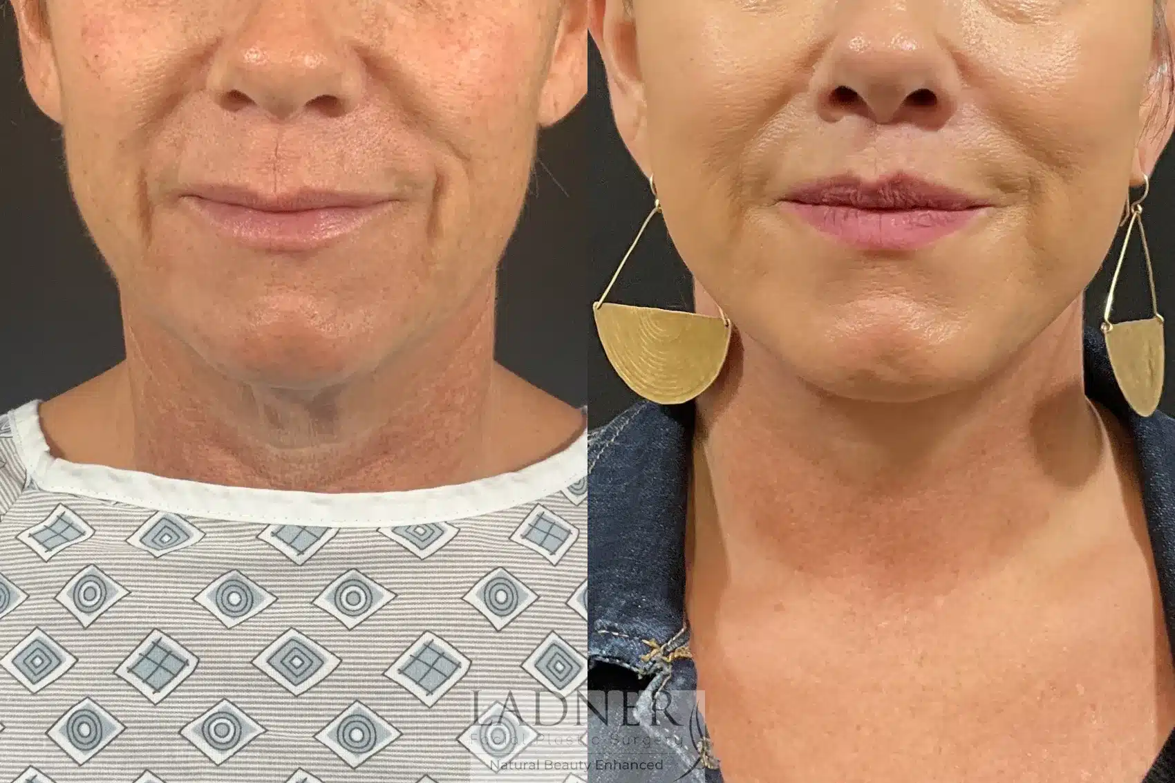 Before and After Image: Deep Plane Face Lift/Neck Lift - front