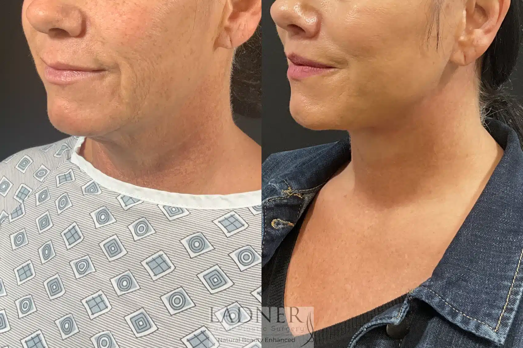 Before and After Image: Deep Plane Face Lift/Neck Lift - left-front-oblique