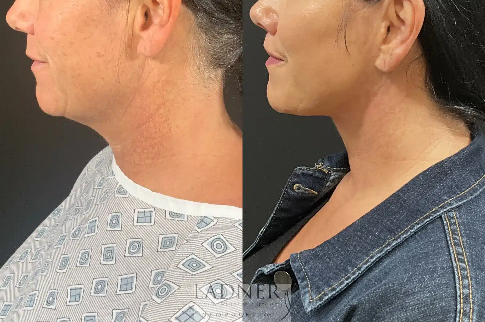 Before and After Image: Deep Plane Face Lift/Neck Lift - left-side