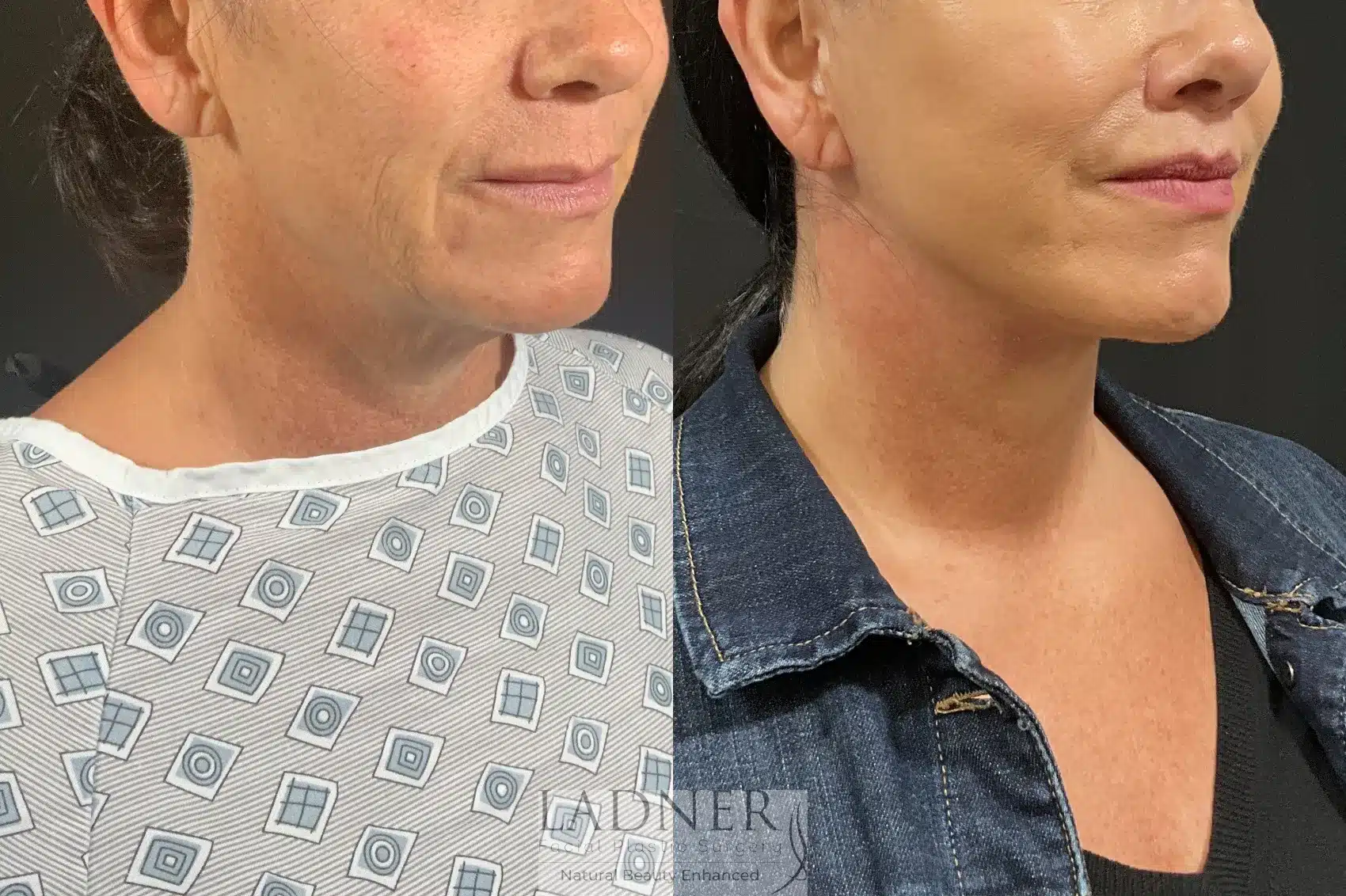Before and After Image: Deep Plane Face Lift/Neck Lift - right-front-oblique