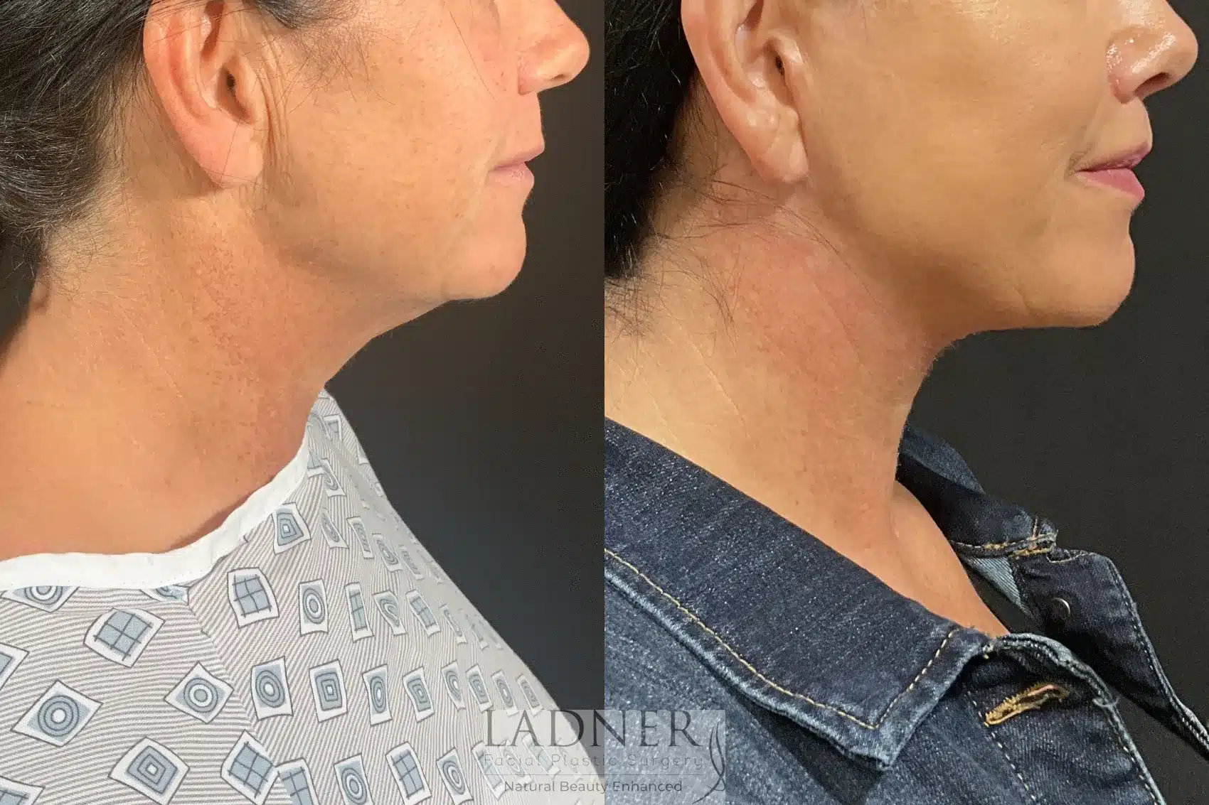 Before and After Image: Deep Plane Face Lift/Neck Lift - right-side