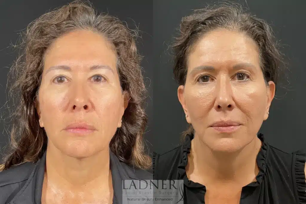 Before and After Image: Deep Plane Lower Facelift - front