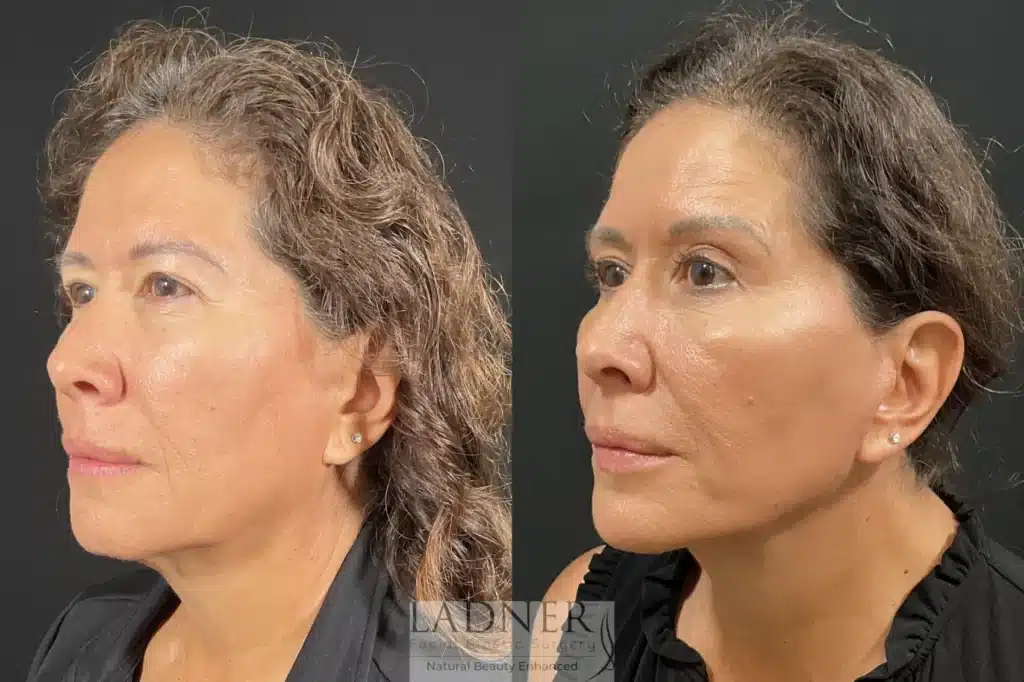 Before and After Image: Deep Plane Lower Facelift - left-front-oblique