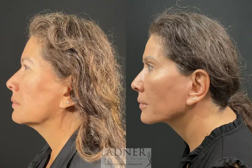 Before and After Image: Deep Plane Lower Facelift - left-side