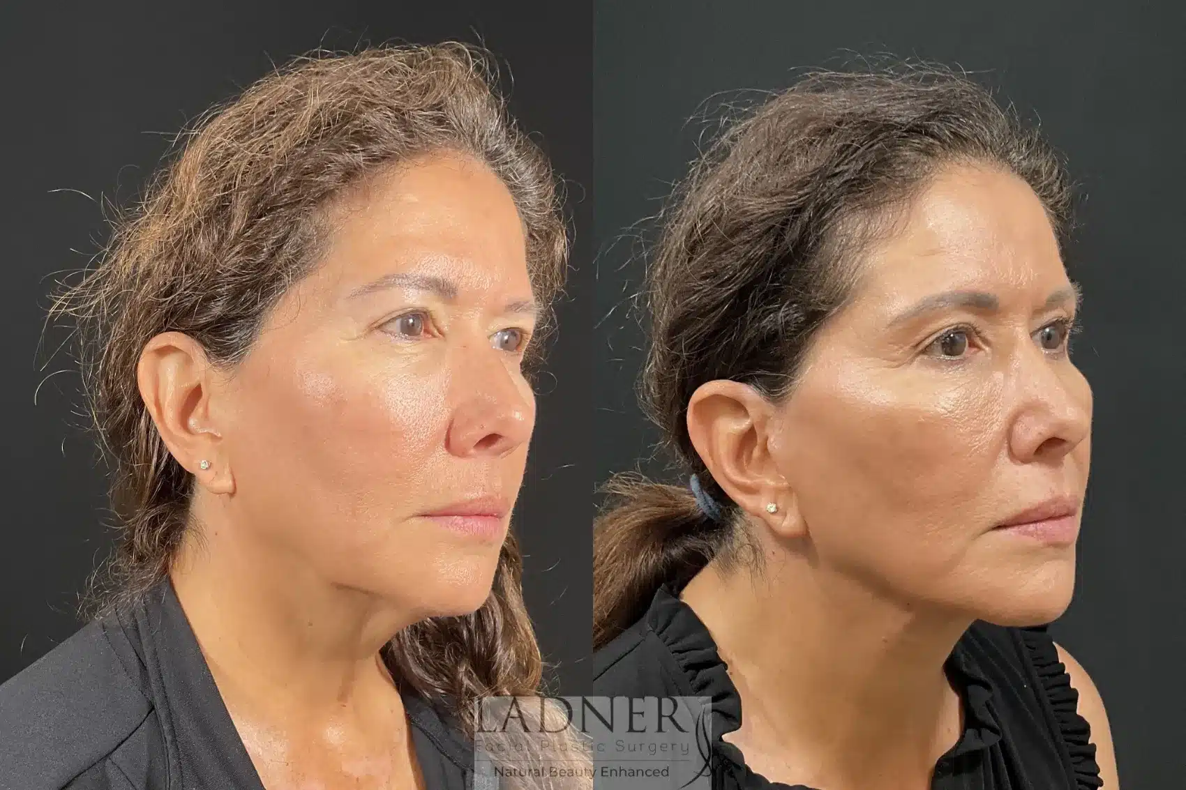 Before and After Image: Deep Plane Lower Facelift - right-front-oblique