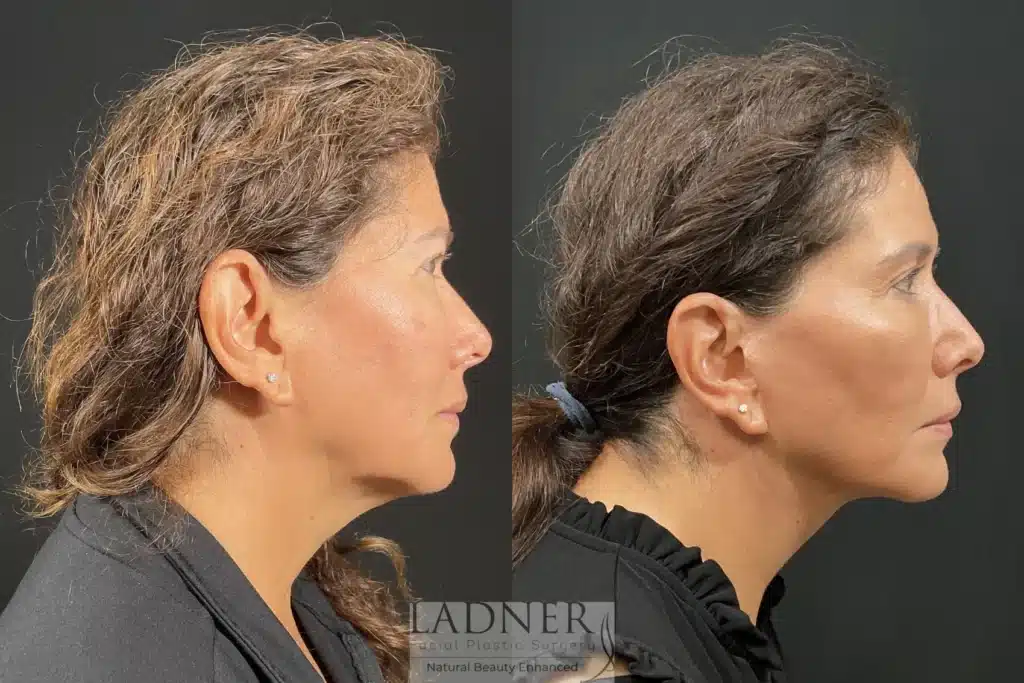 Before and After Image: Deep Plane Lower Facelift - right-side