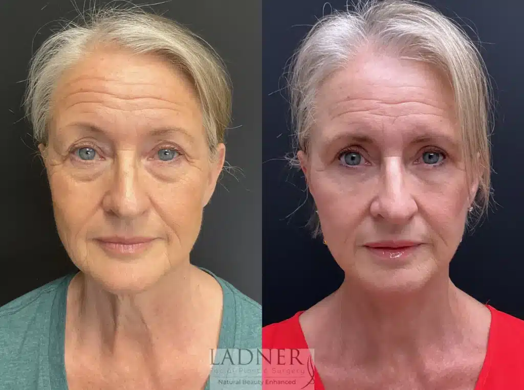 Before and After Image: Lower Deep Plane Facelift/Neck Lift, Blepharoplasty, and Facial Fat Transfer - front