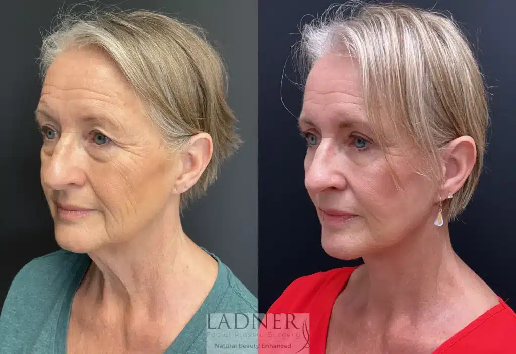 Before and After Image: Lower Deep Plane Facelift/Neck Lift, Blepharoplasty, and Facial Fat Transfer - left-front-oblique