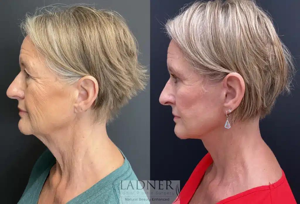 Before and After Image: Lower Deep Plane Facelift/Neck Lift, Blepharoplasty, and Facial Fat Transfer - left-side