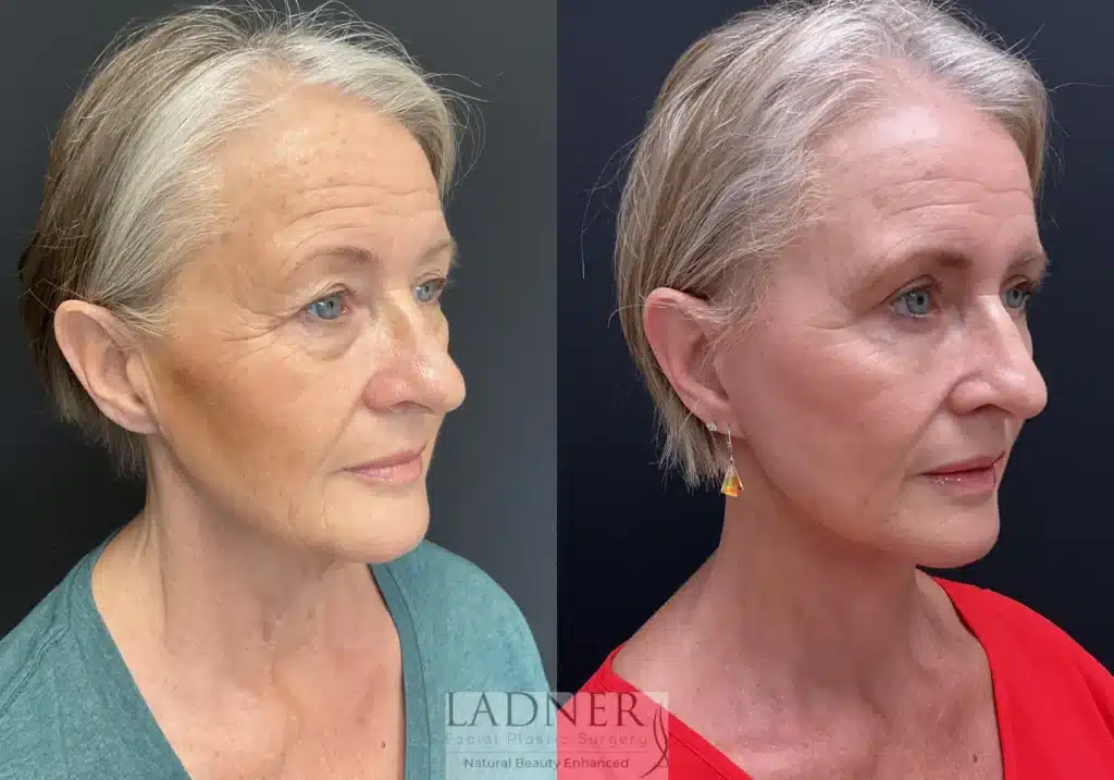 Before and After Image: Lower Deep Plane Facelift/Neck Lift, Blepharoplasty, and Facial Fat Transfer - right-front-oblique