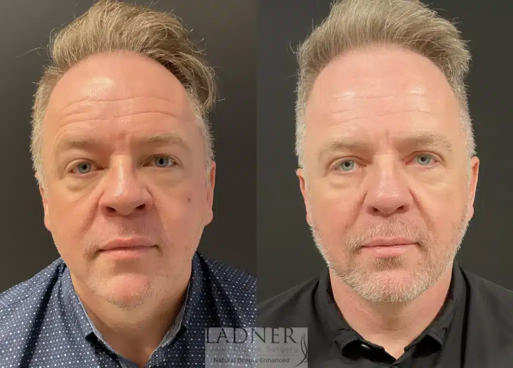 Before and After Image: Deep Plane Facelift, Blepharoplasty, Submental Liposuction, Fat Transfer, and Facial Plastic Surgery for Men - front