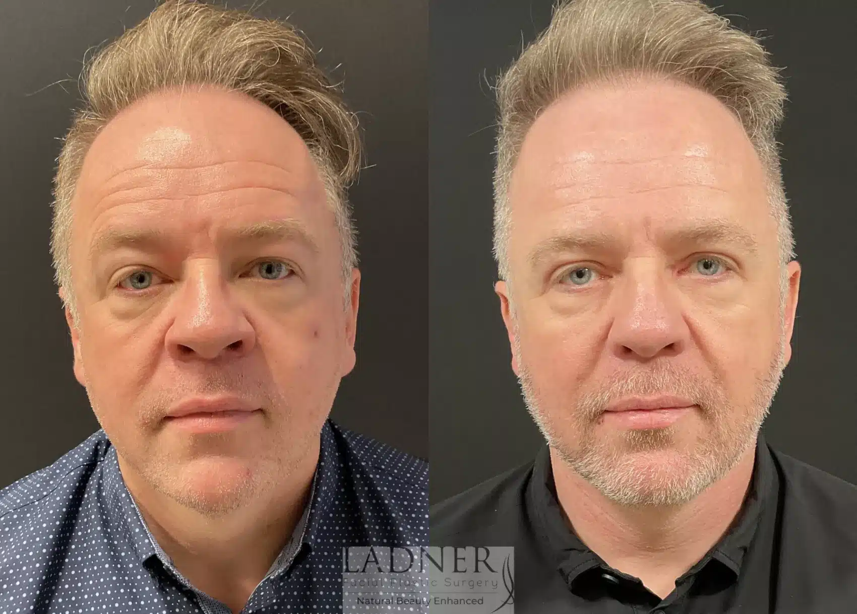 Before and After Image: Deep Plane Facelift - front