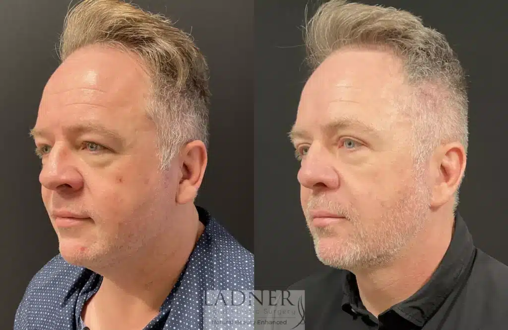 Before and After Image: Deep Plane Facelift, Blepharoplasty, Submental Liposuction, Fat Transfer, and Facial Plastic Surgery for Men - left-front-oblique