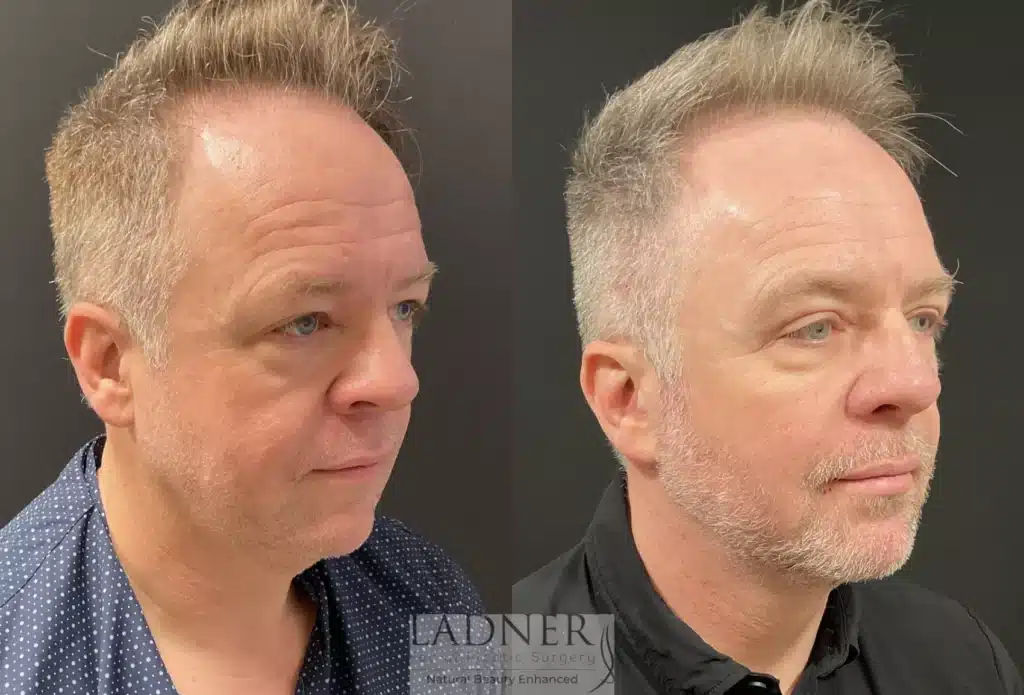 Before and After Image: Deep Plane Facelift, Blepharoplasty, Submental Liposuction, Fat Transfer, and Facial Plastic Surgery for Men - right-front-oblique