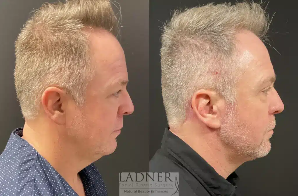 Before and After Image: Deep Plane Facelift, Blepharoplasty, Submental Liposuction, Fat Transfer, and Facial Plastic Surgery for Men - right-side