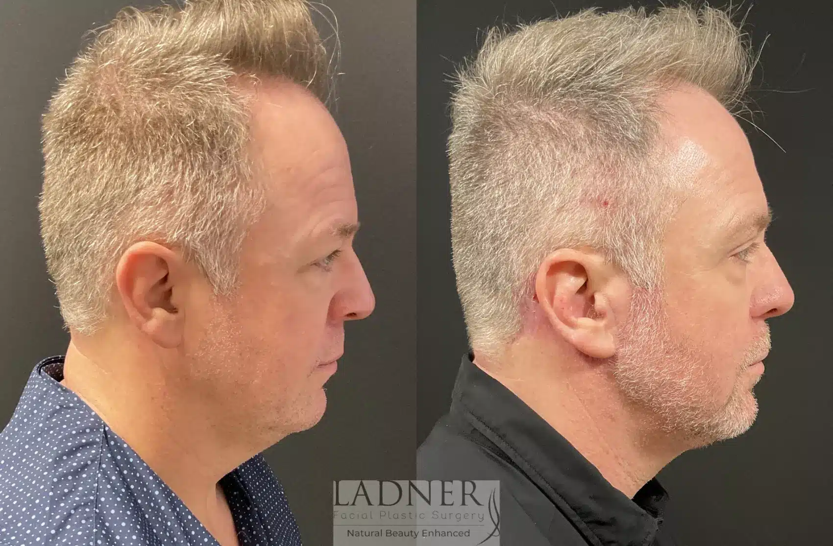 Before and After Image: Deep Plane Facelift - right-side