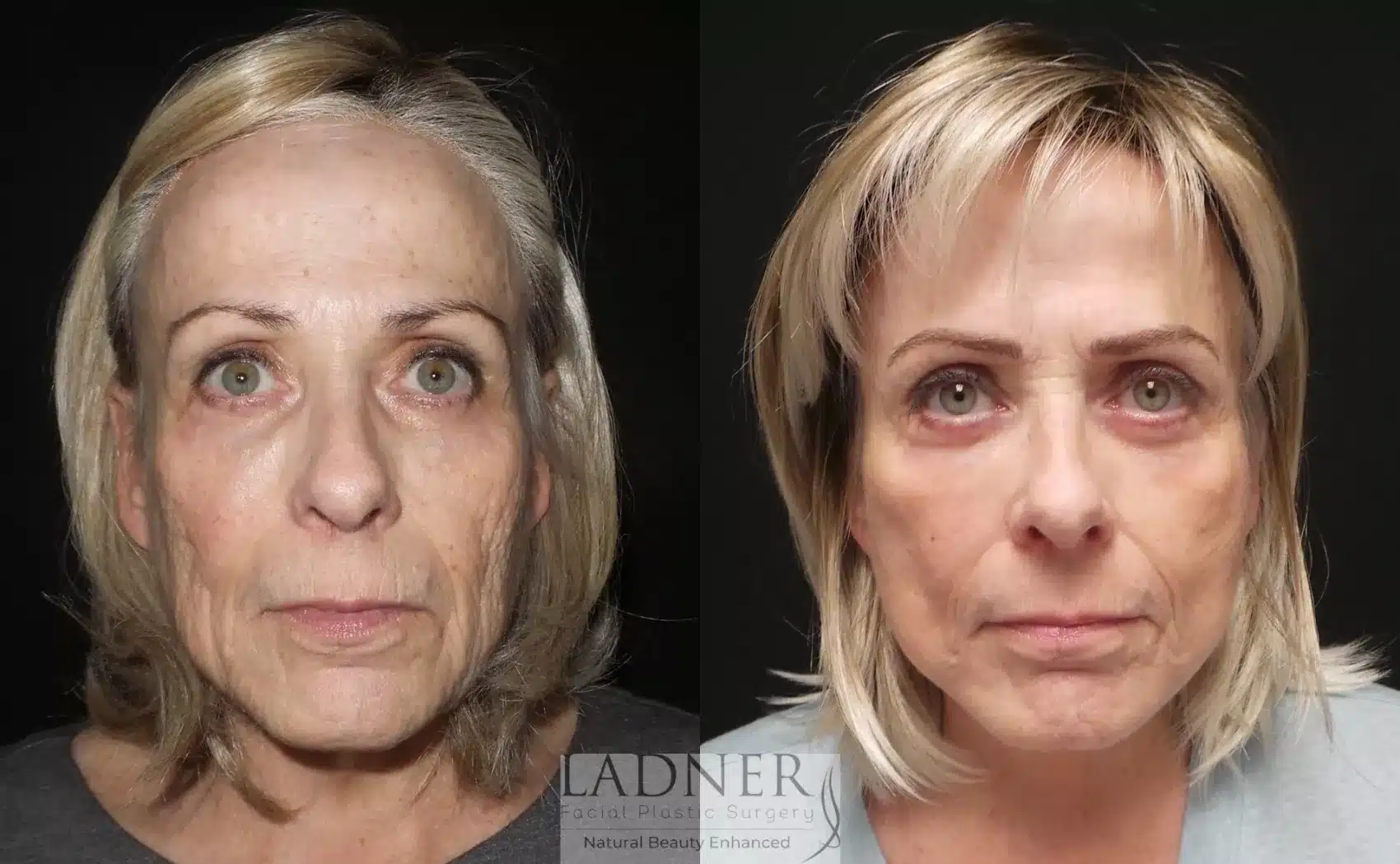 Before and After Image: Deep Plane Face Lift - front