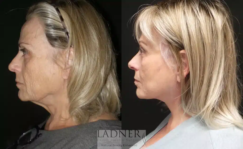 Before and After Image: Deep Plane Face Lift - left-side