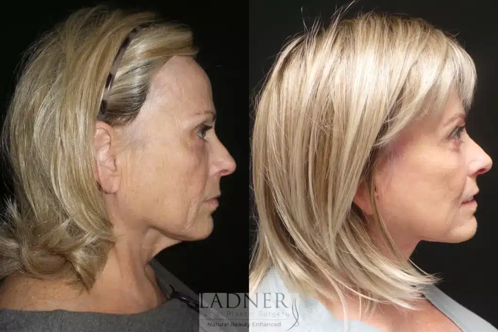 Before and After Image: Deep Plane Face Lift - right-side