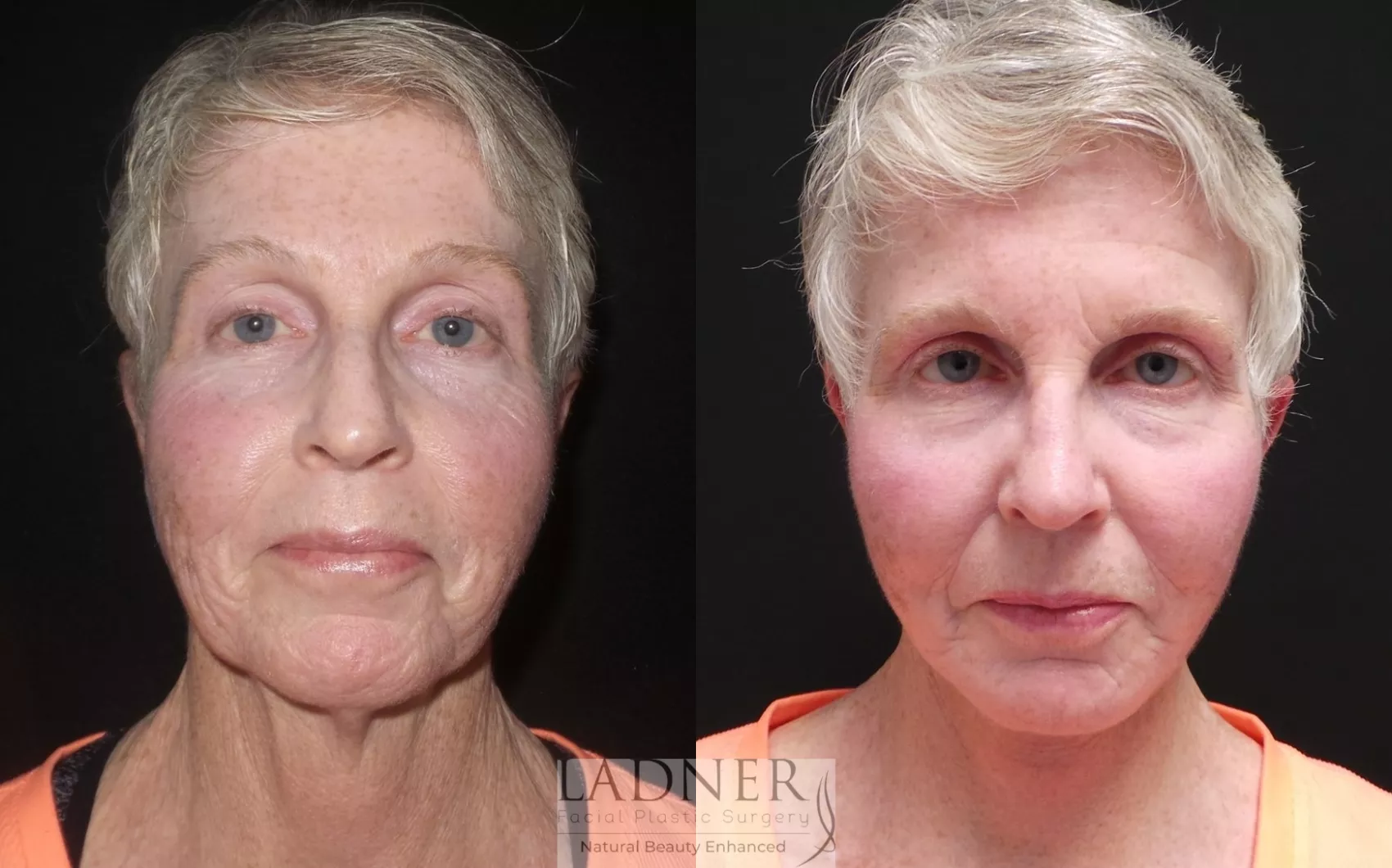 Before and After Image: Deep Plane Neck Lift - front