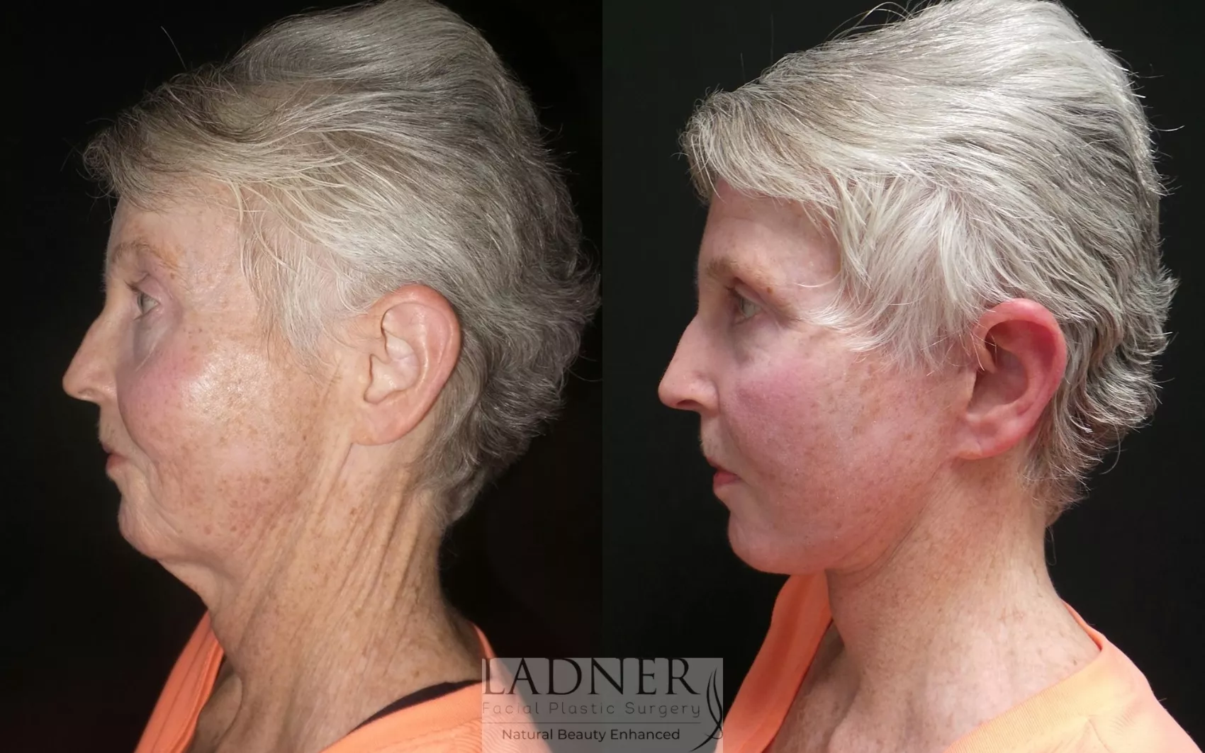 Before and After Image: Deep Plane Neck Lift - left-side