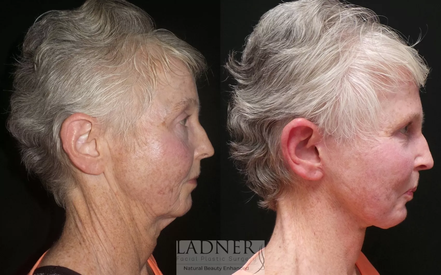 Before and After Image: Deep Plane Neck Lift - right-side