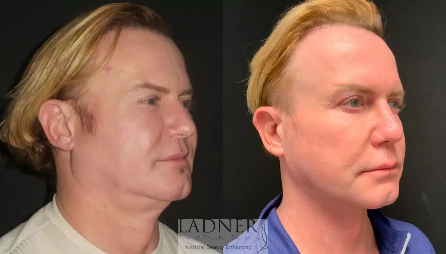Before and After Image: Deep Plane Facelift - right-front-oblique