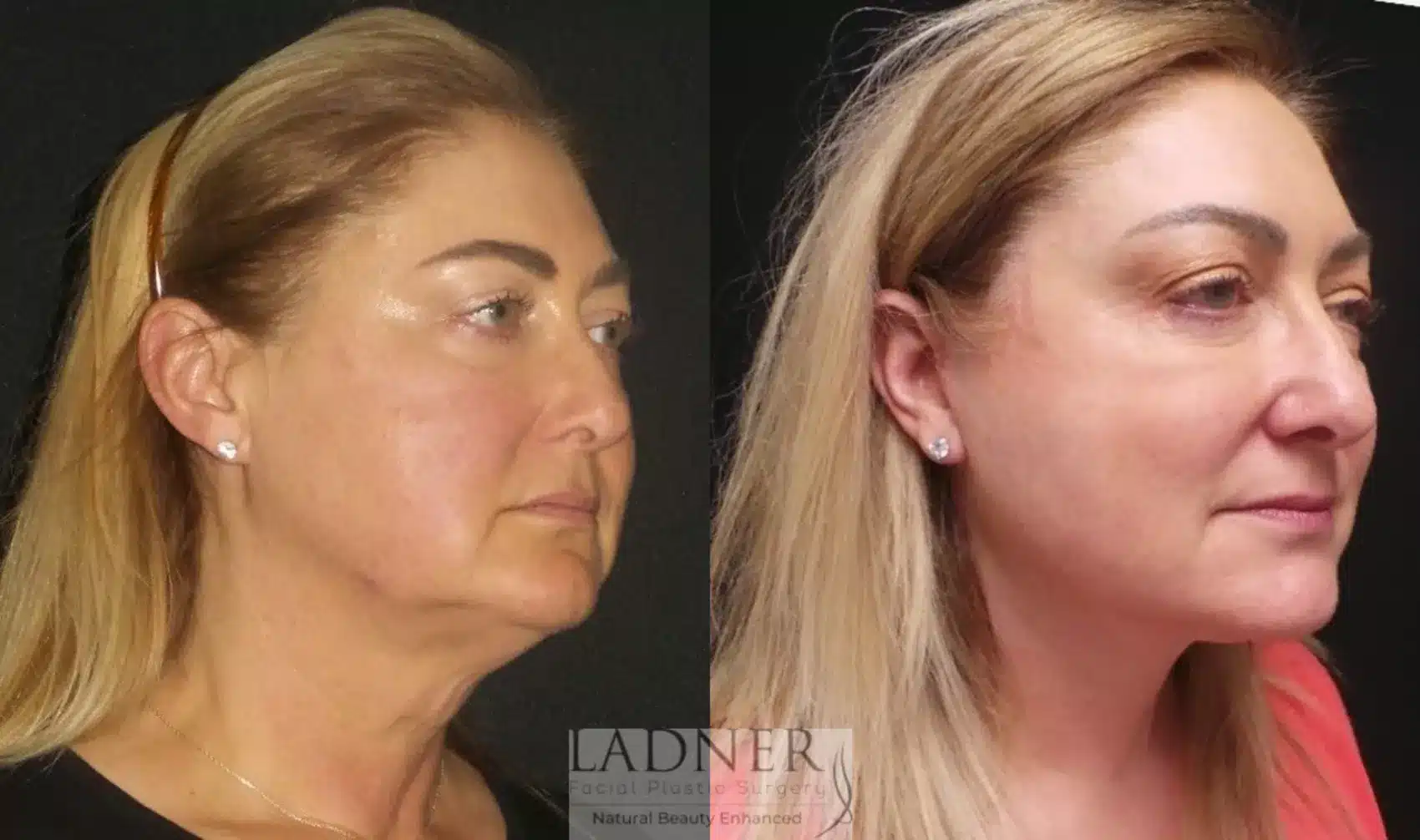 Before and After Image: Deep Plane Necklift - right-front-oblique