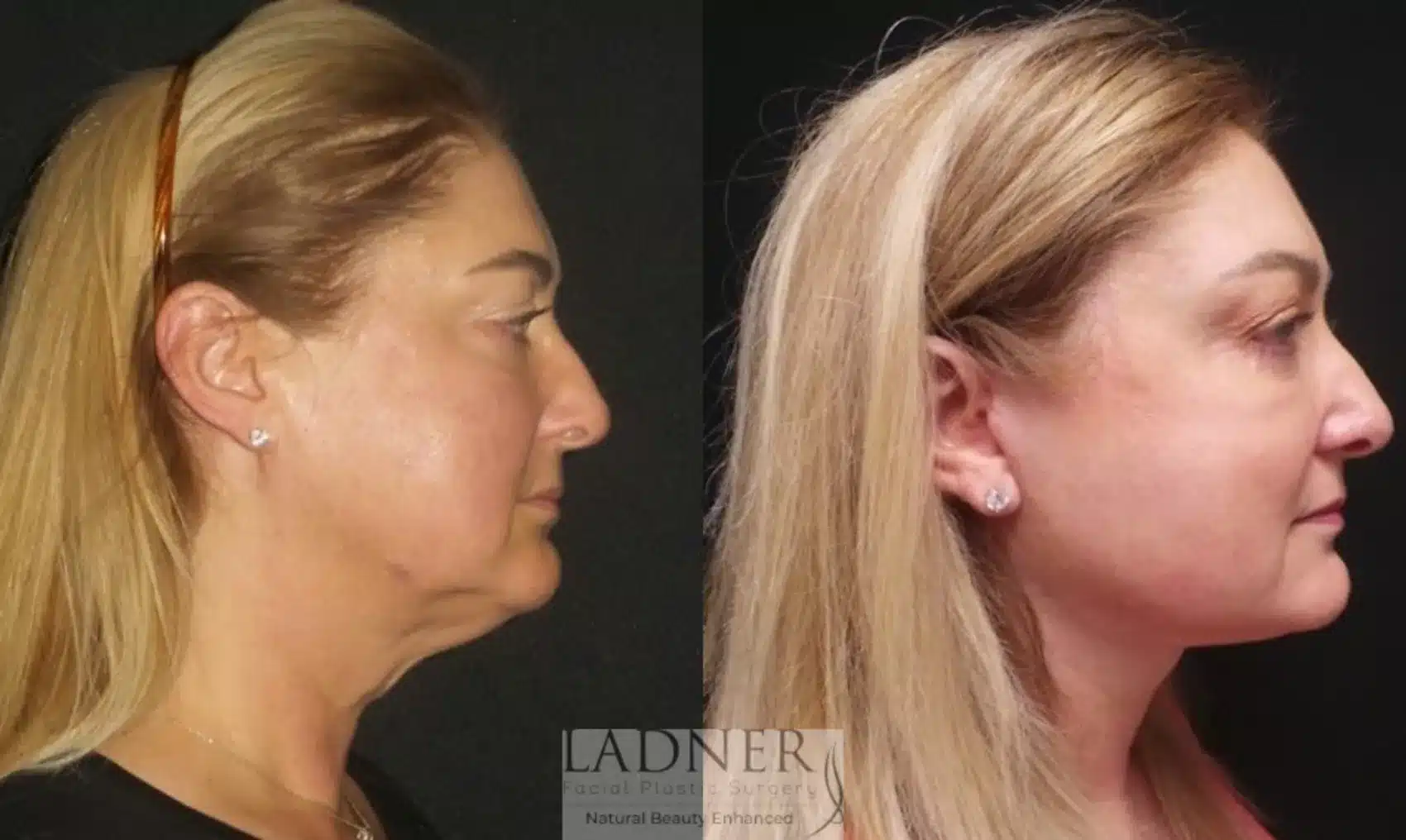 Before and After Image: Deep Plane Necklift - right-side