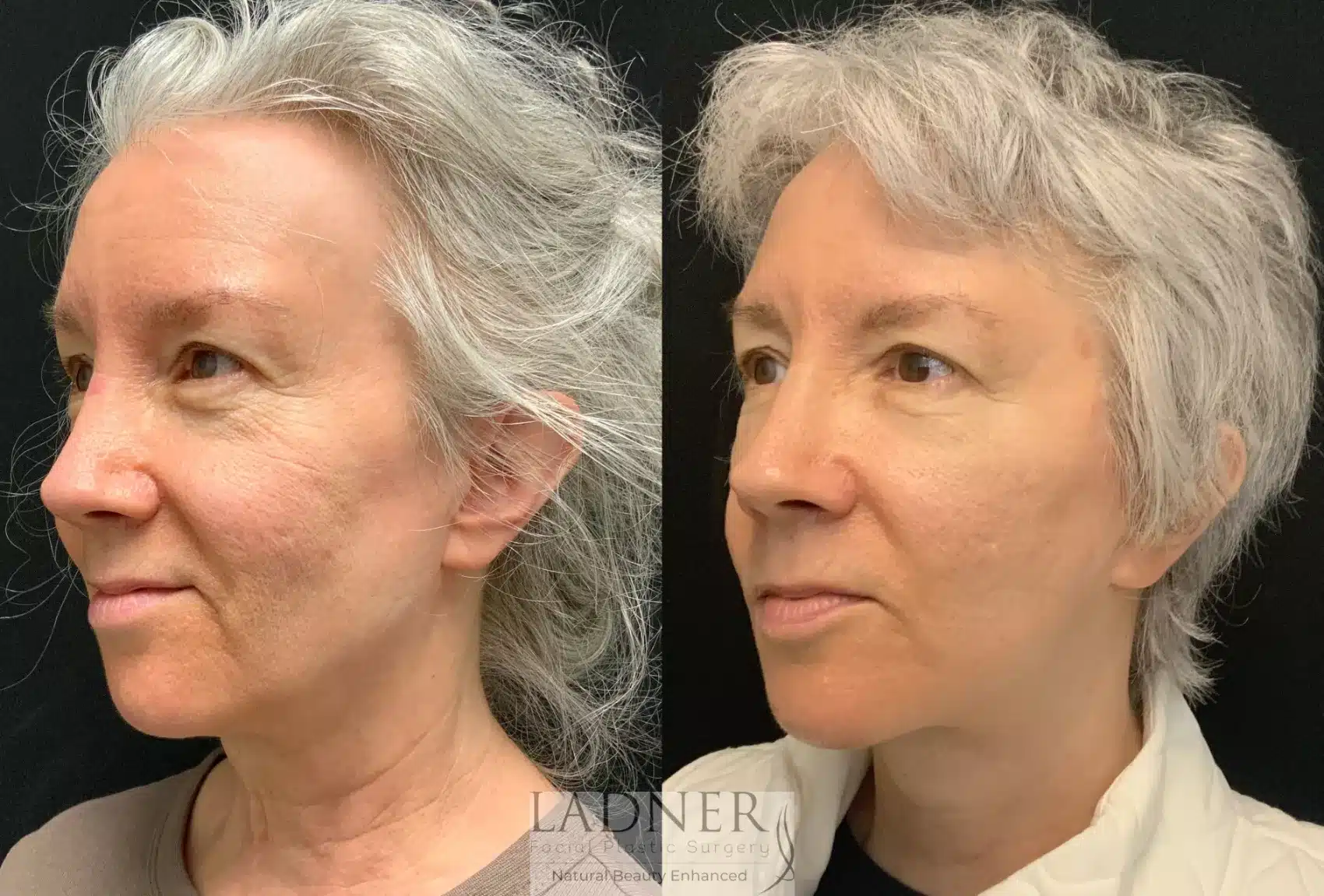 Before and After Image: Neck Lift - left-front-oblique