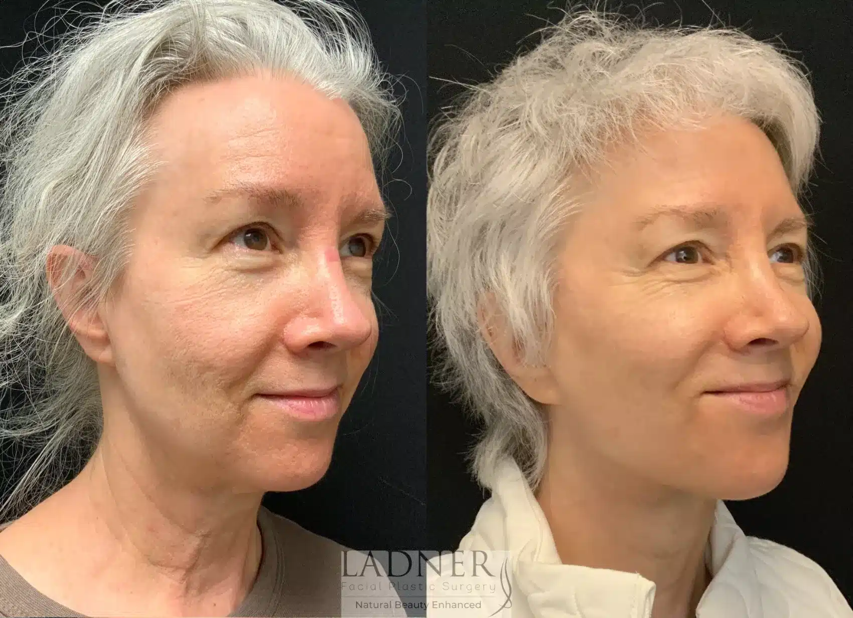 Before and After Image: Neck Lift - right-front-oblique