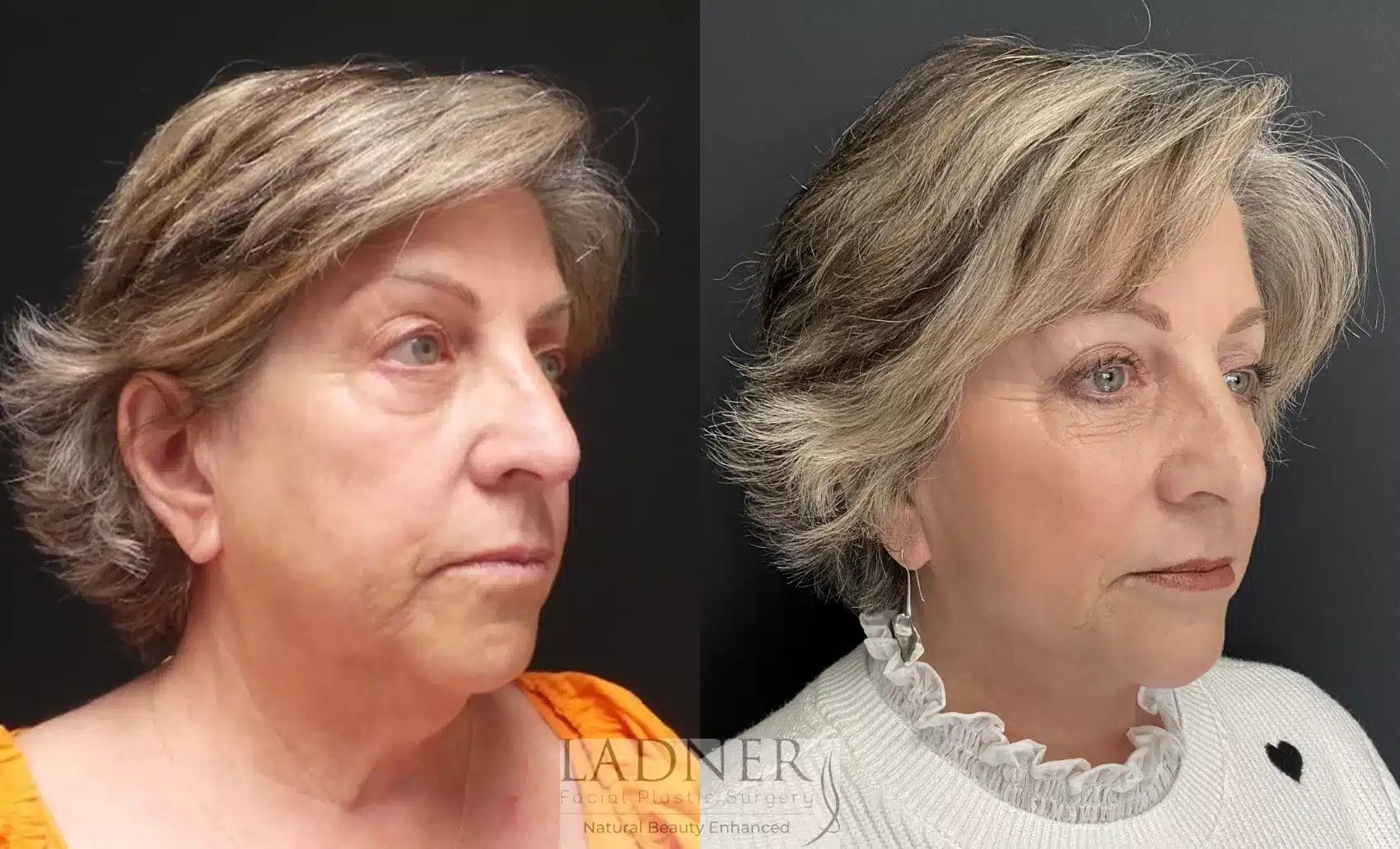 Before and After Image: Deep Plane Facelift - right-front-oblique