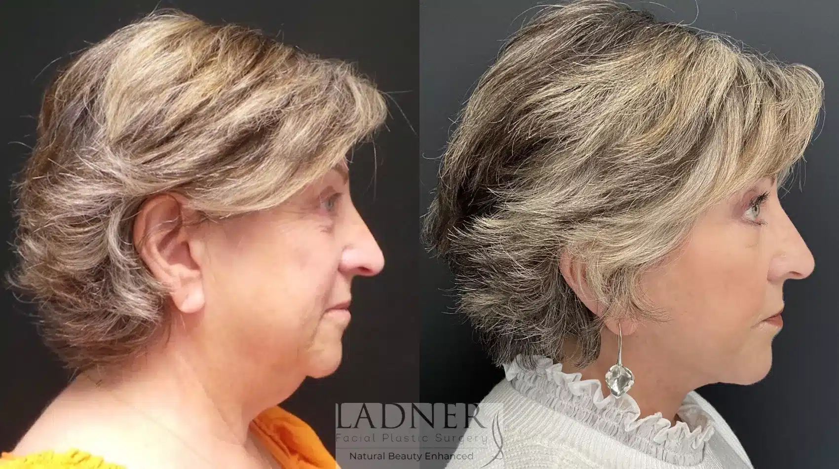 Before and After Image: Deep Plane Facelift - right-side