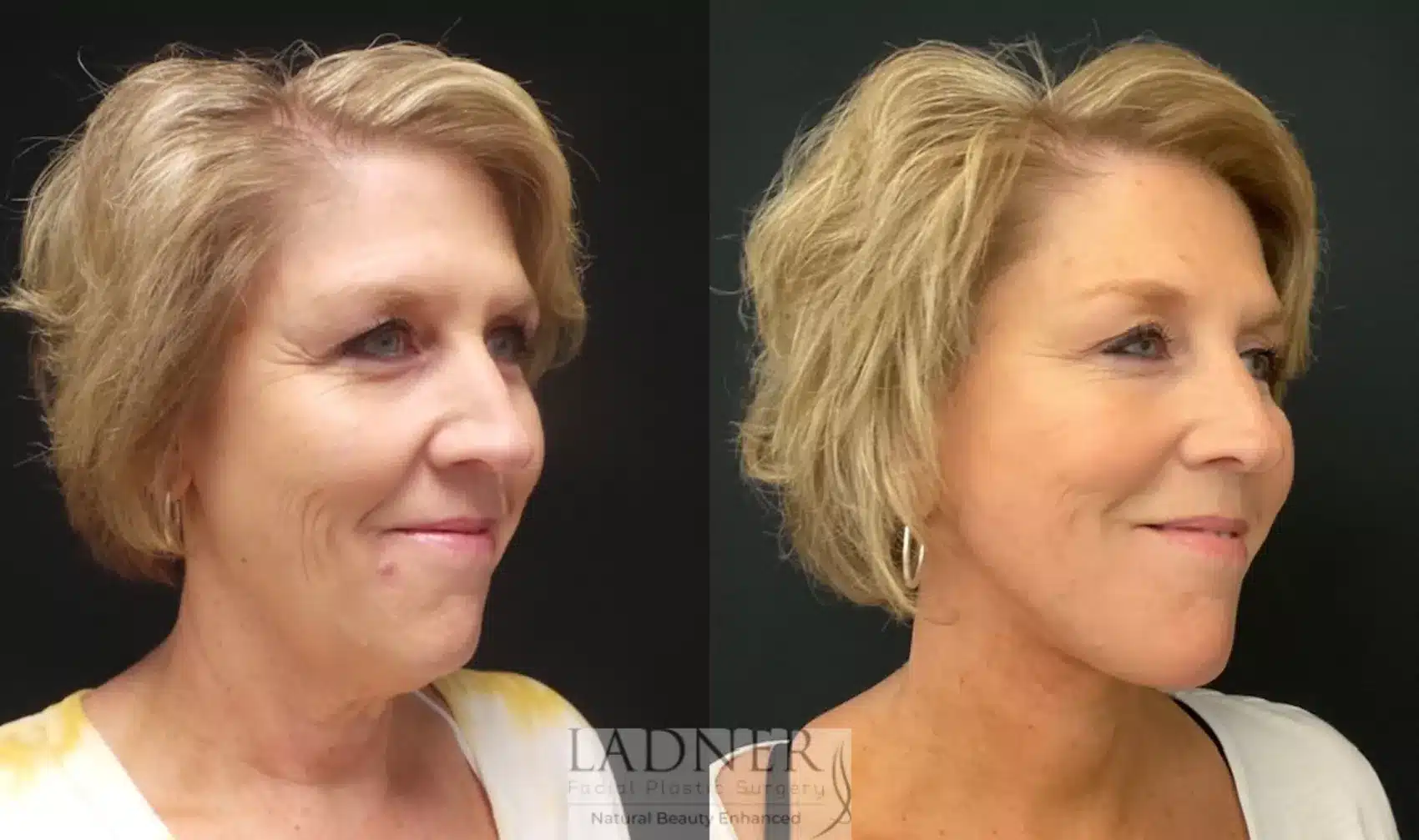 Before and After Image: Deep Plane Facelift - right-front-oblique