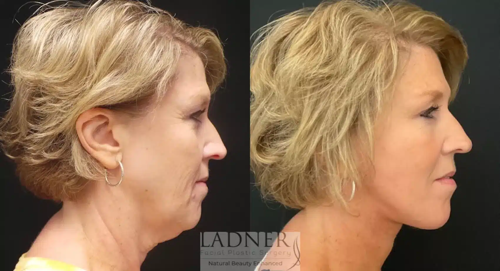 Before and After Image: Deep Plane Facelift - right-side