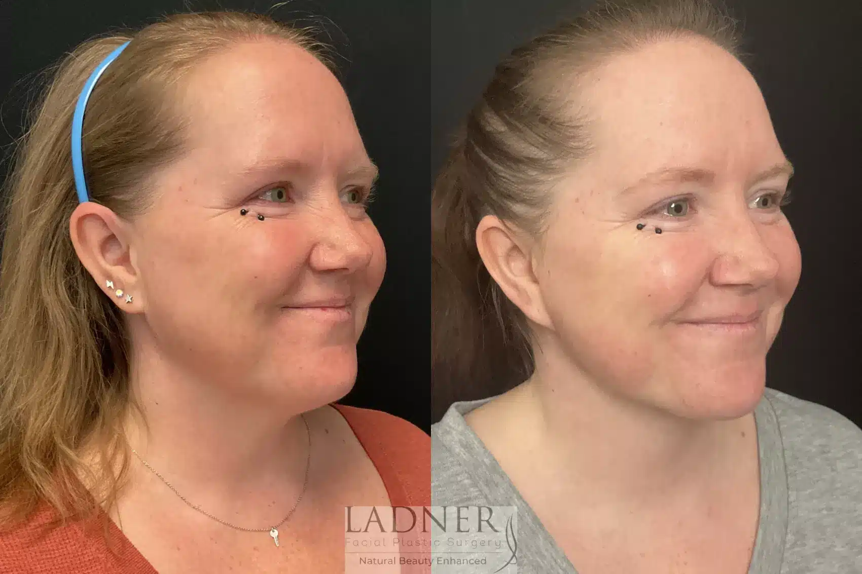 Before and After Image: Deep Plane Necklift - right-front-oblique