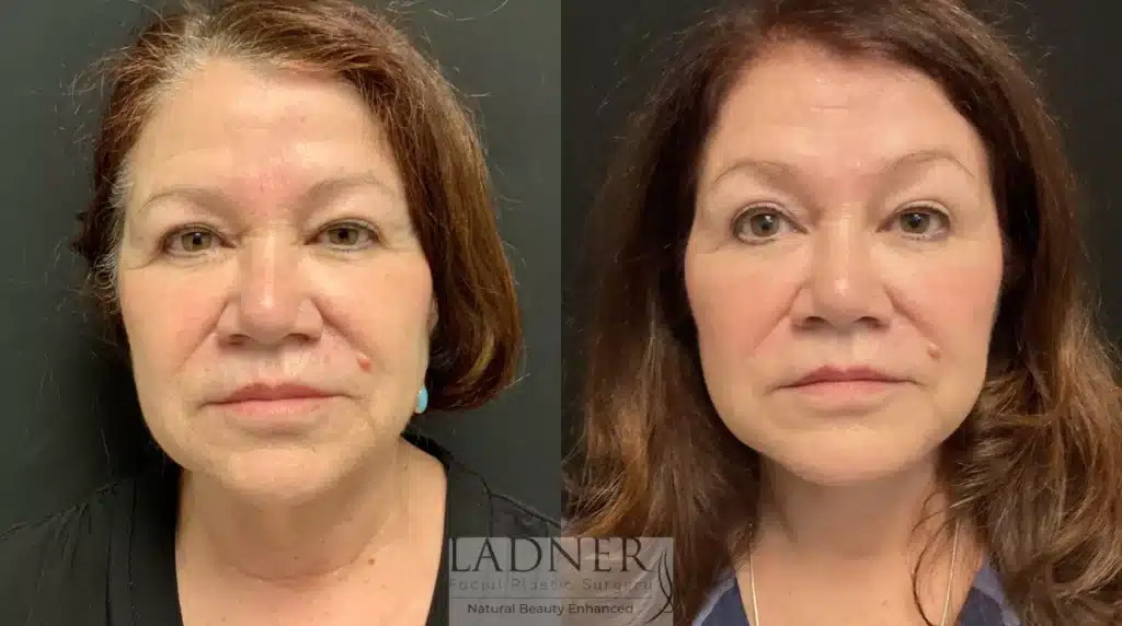 Before and After Image: Lower Deep Plane Facelift/Deep Neck Lift - front