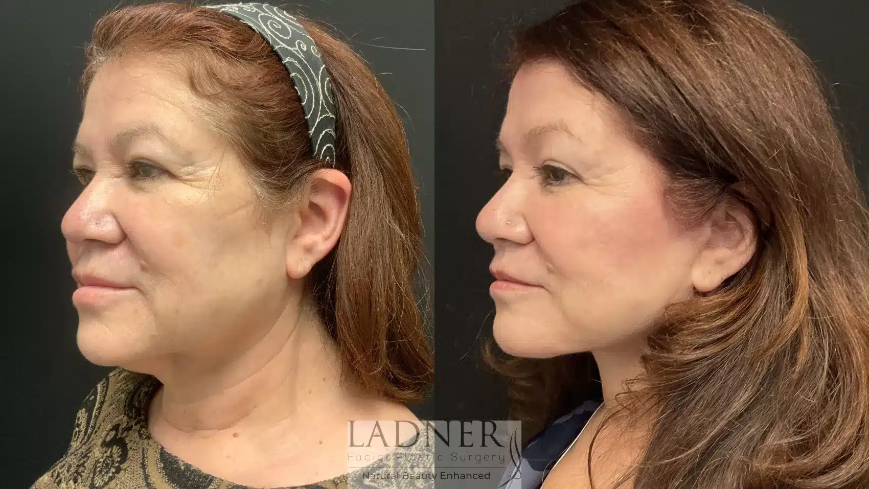 Before and After Image: Lower Deep Plane Facelift/Deep Neck Lift - left-front-oblique