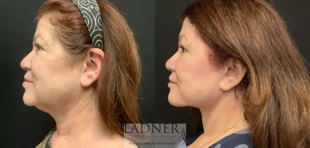 Before and After Image: Lower Deep Plane Facelift/Deep Neck Lift - left-side
