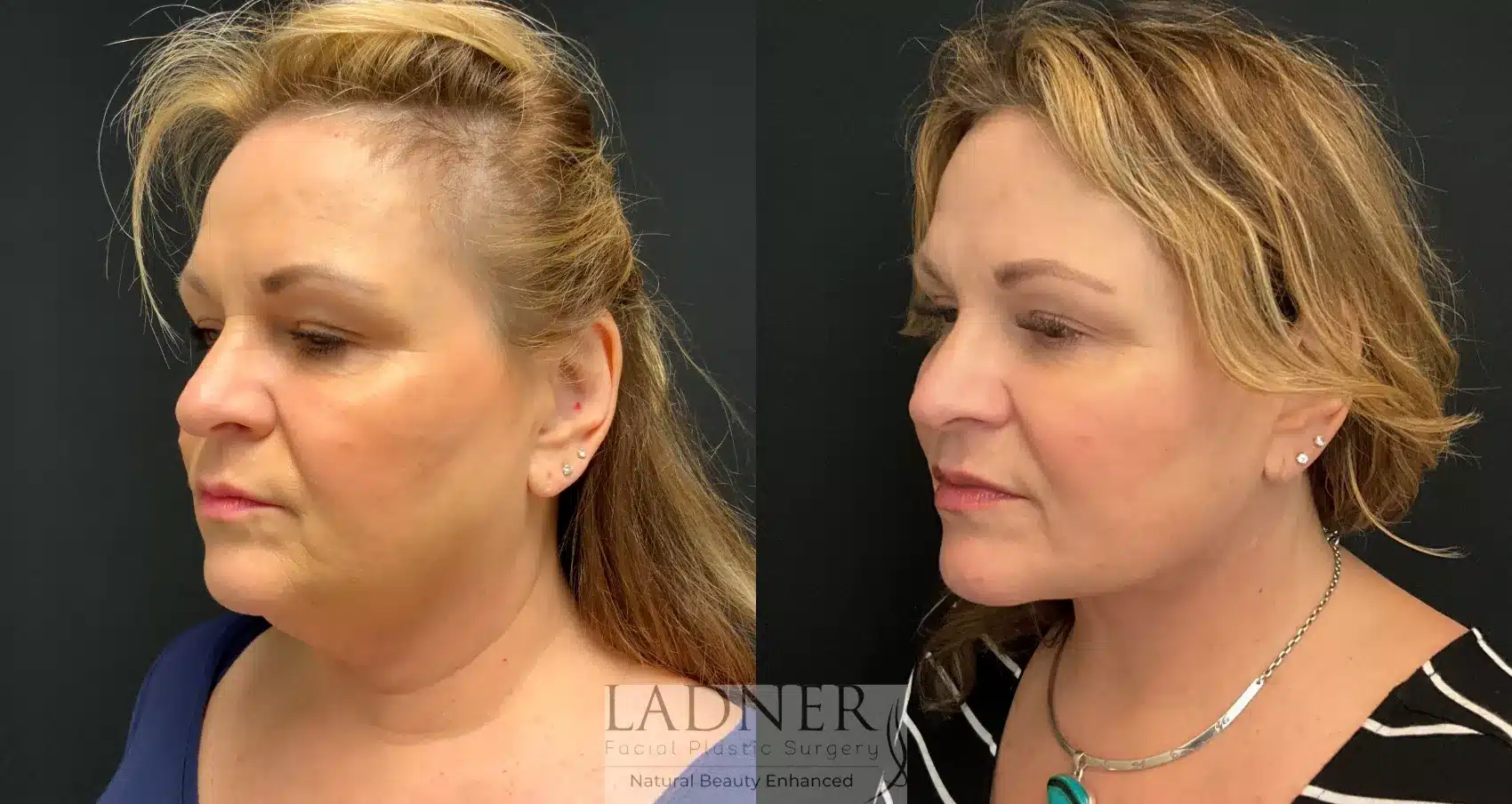 Before and After Image: Deep Plane Facelift - left-front-oblique