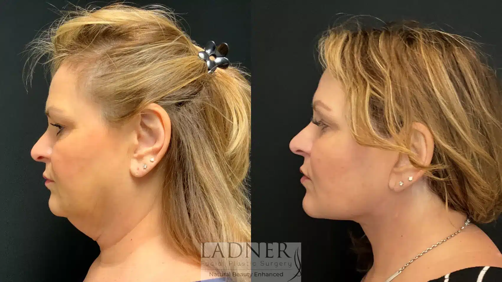 Before and After Image: Deep Plane Facelift - left-side