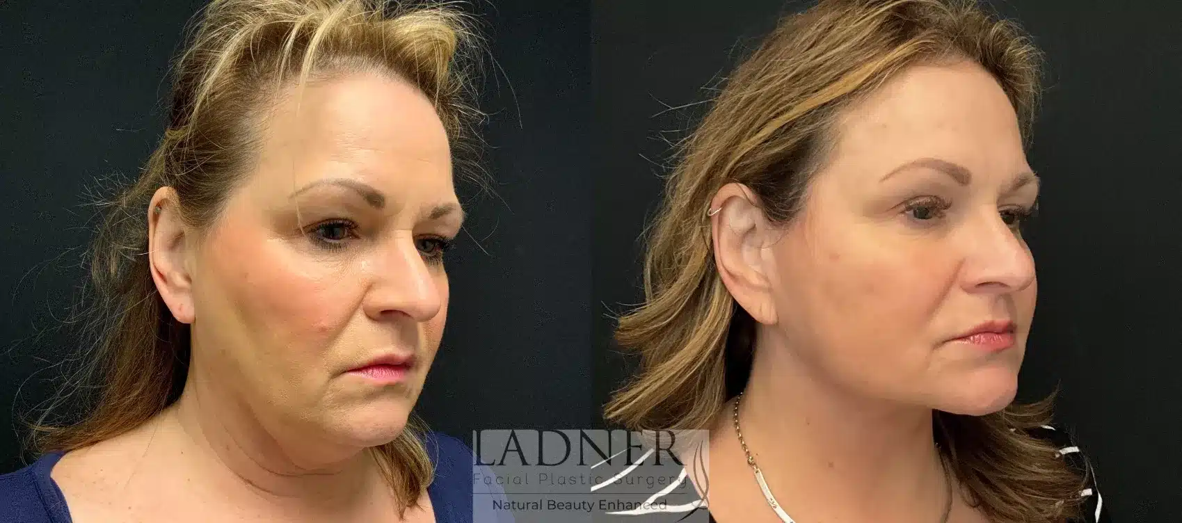 Before and After Image: Deep Plane Facelift - right-front-oblique