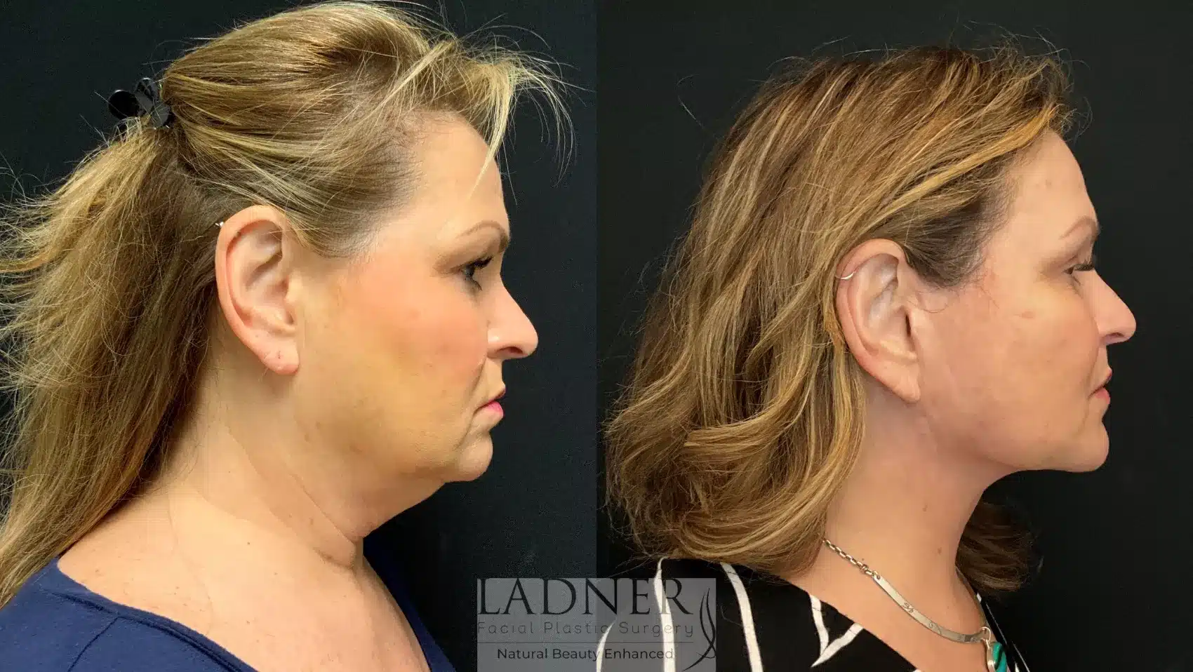 Before and After Image: Deep Plane Facelift - right-side