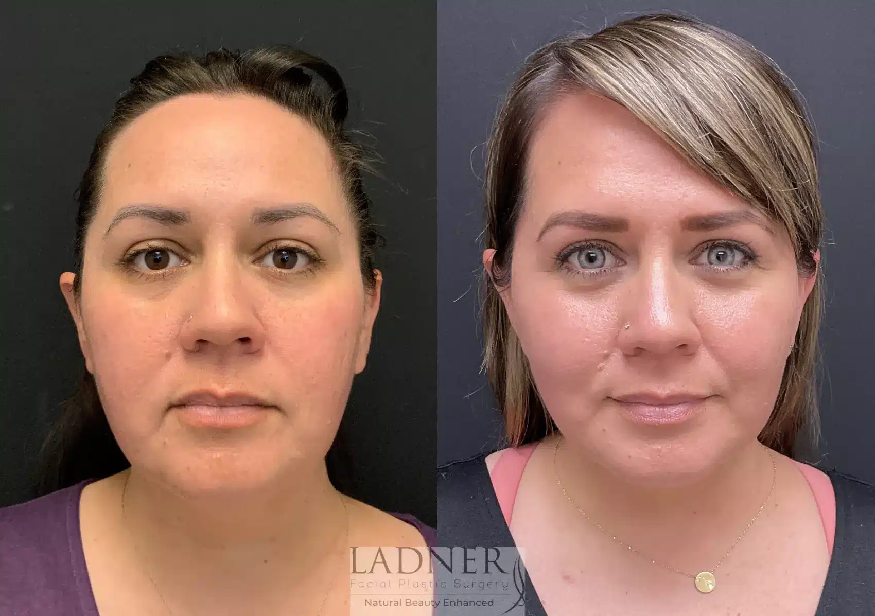 Before and After Image: Deep Plane Facelift / Neck Lift - front
